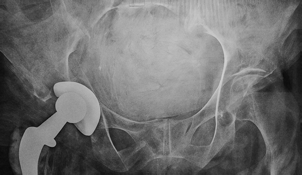 2023-01-26-2-Broken-hip-confirmed-with-hip-replacement-cup-pushed-inward-from-fall—irreparable-due-to-age-of-patient-Edit.jpg